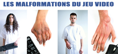 Top des malformations liées aux Jeux Video